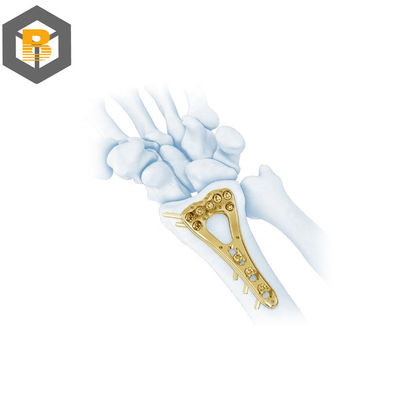 Partie d'usinage de précision CNC à l'aide d'une plaque de verrouillage à broche à rayon distale multi-axial